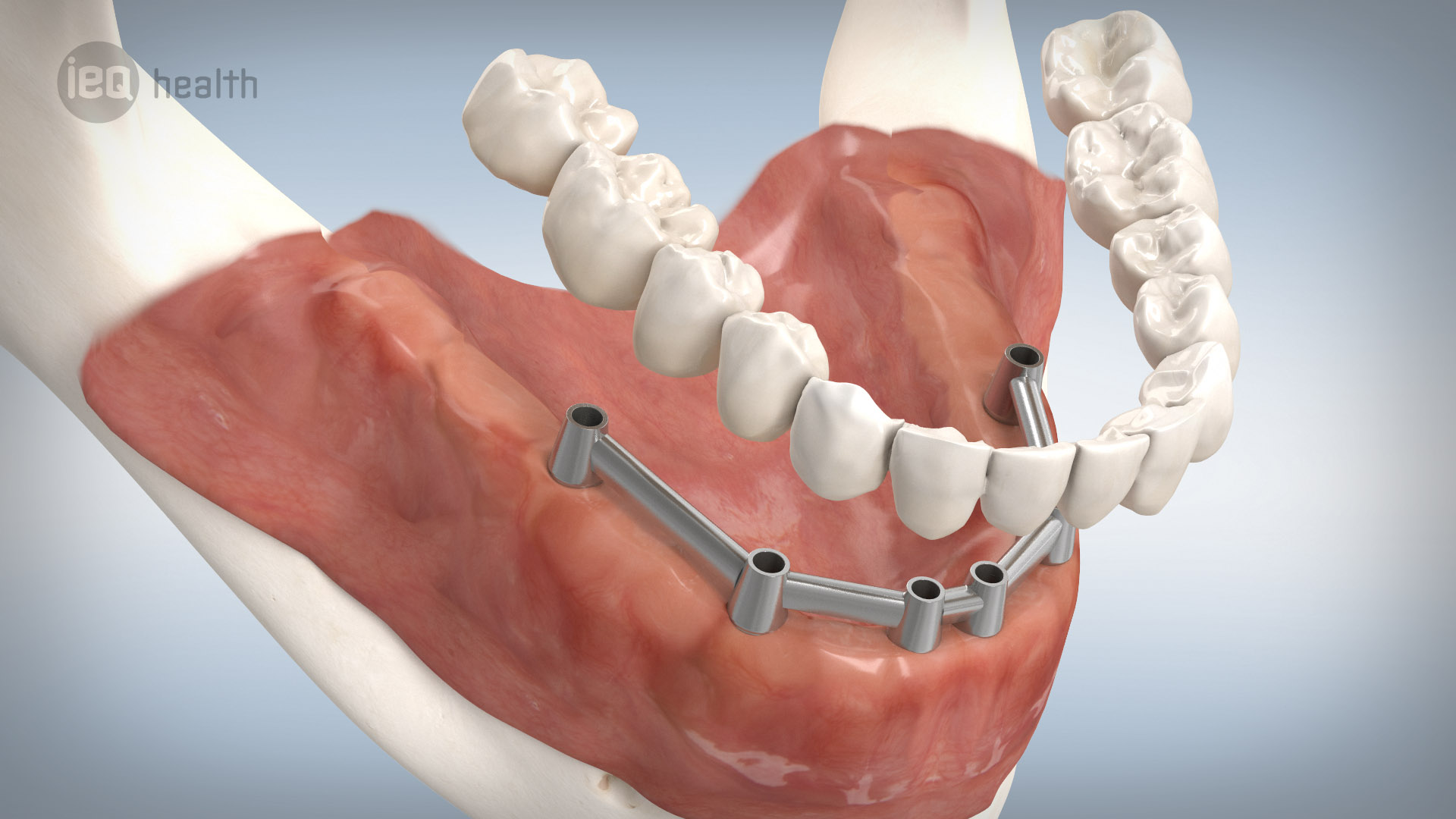 Dr Bernhard Warnick Abensberg Erfolgreiche Implantationen Voraussetzungen