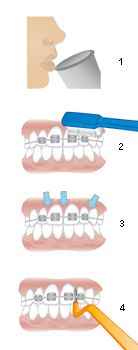 zahnpflegehinweise bei einer festen spange
