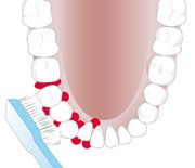 Zahnfehlstellungen erschweren die Reinigung