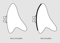 Versiegelung der Zahnoberfläche